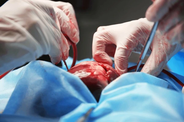 How Heart Transplant Surgery Can Save Lives And Improve Health