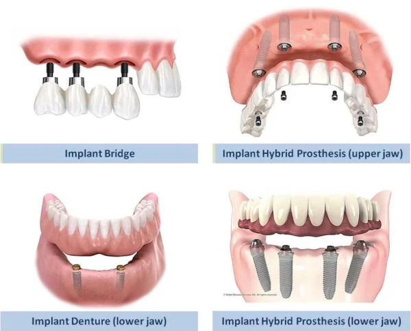 Exploring the Different Types of Dental Implants for a Perfect Smile