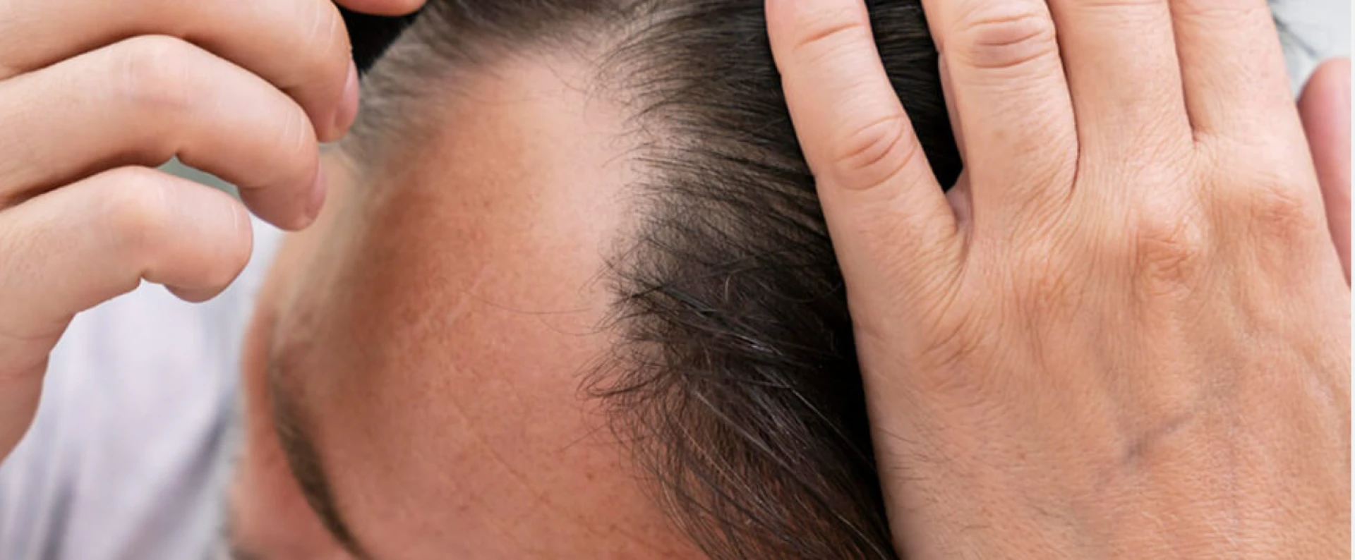 Why Advanced Hair Restoration Is Changing Lives