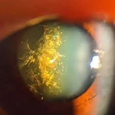 Christmas Tree Cataract: Symptoms, Causes, and Treatment | Dr. Agarwal