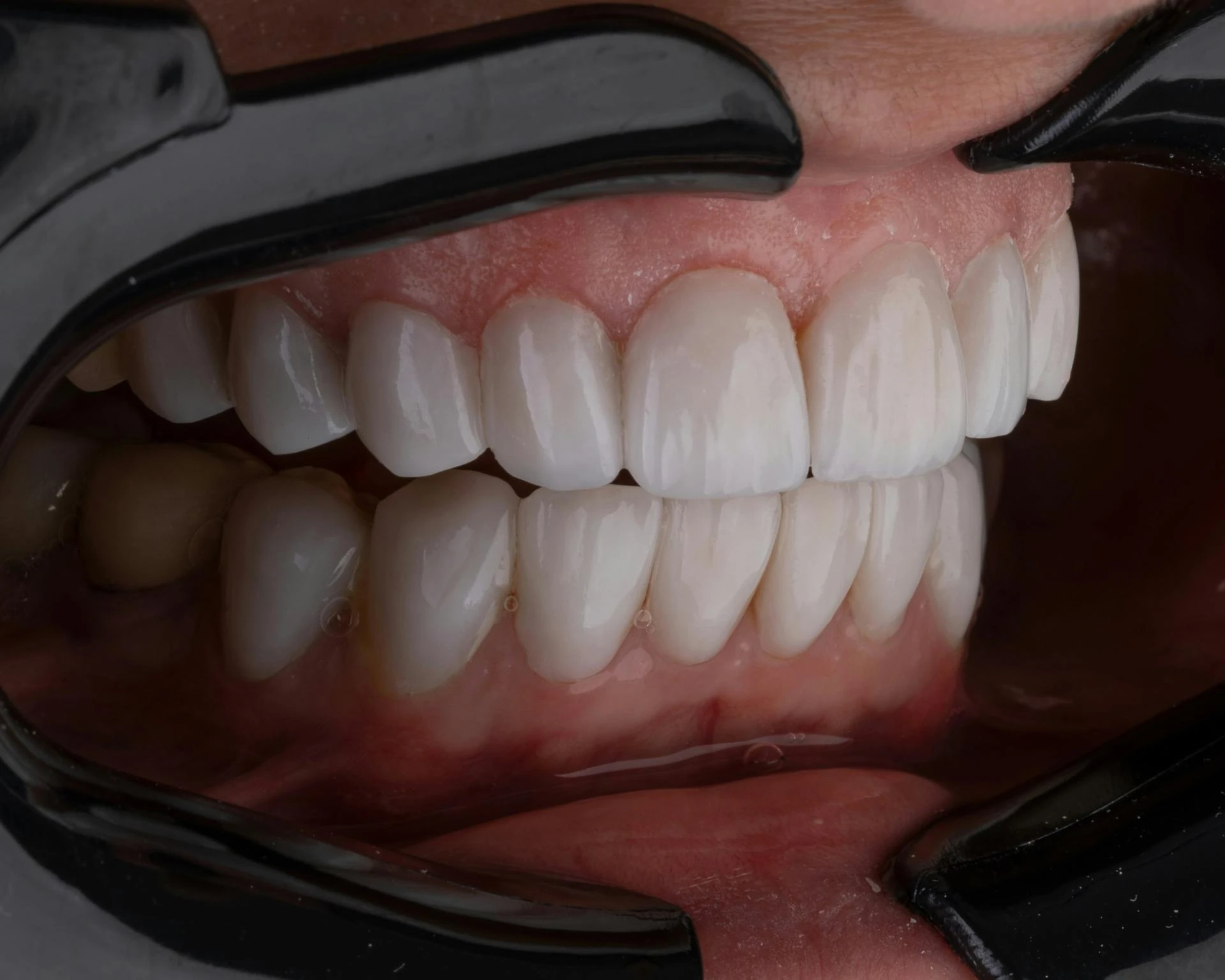 Emergency Dentist Brisbane: Fast, Affordable, and Caring Dental Care When You Need It Most