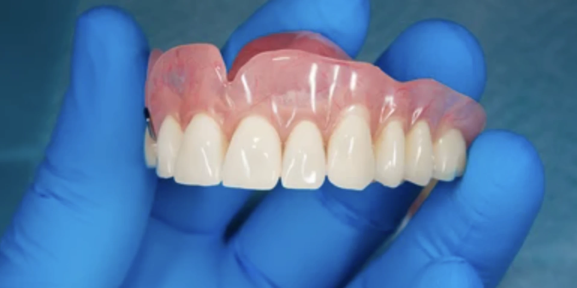 Choosing Dentures for Front Teeth: Expert Tips and Advice
