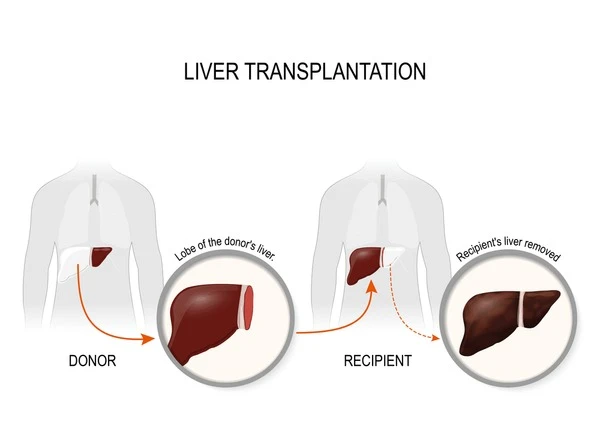 When Do You Need Liver Replacement Surgery? Signs And Treatment Options