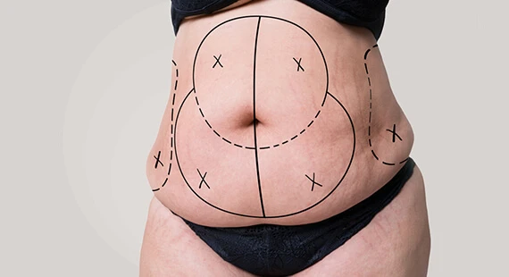 Difference Between Full &amp; Mini Tummy Tuck Surgery