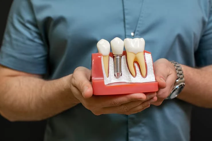 How Much Do Dental Implants Cost in Birmingham?