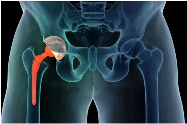The Future of Hip Surgery: Direct Anterior Approach for Total Hip Replacement in Delhi
