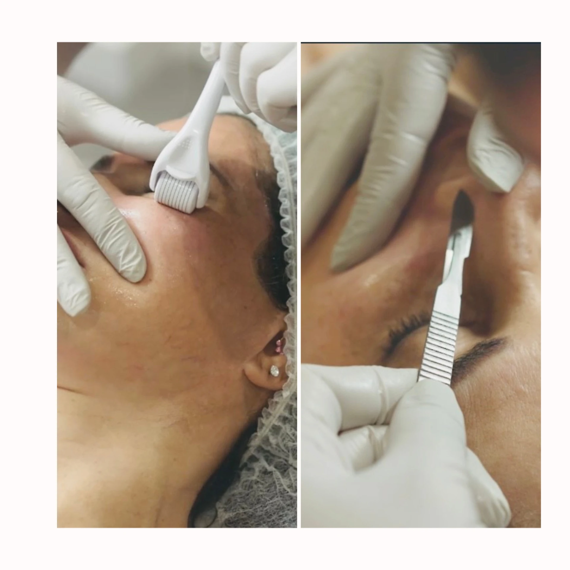 Dermaplaning vs. Microneedling: Which Is Right for Your Clients?