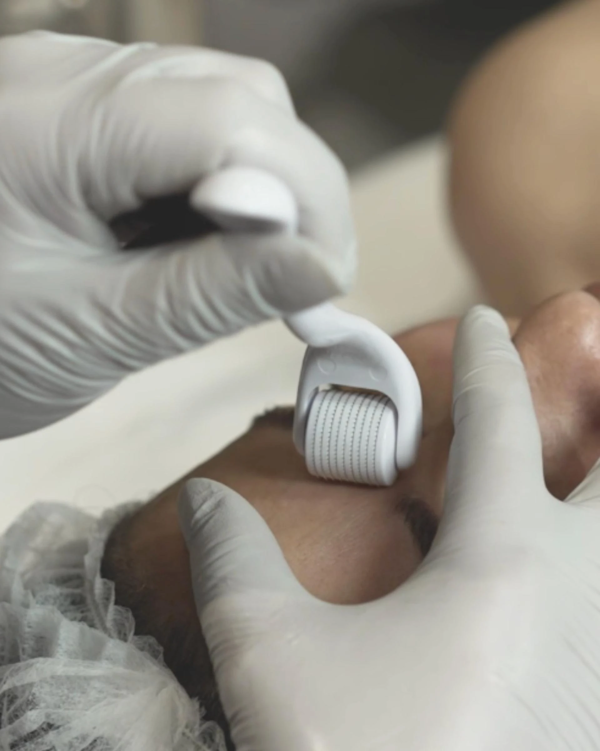 Skin needling and how it improves the health of the skin