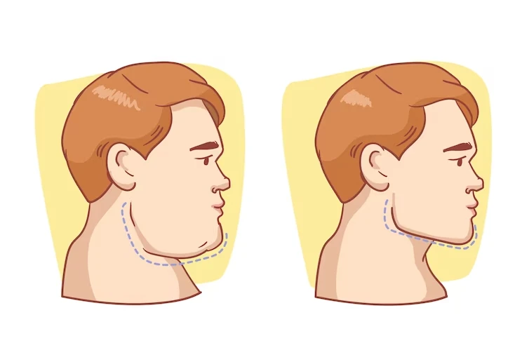 How to Get Rid of Double Chin: Natural and Surgical Treatment Options