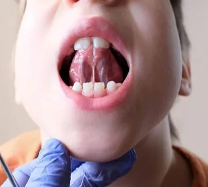 Better Sleep, Better Health: Myofunctional Therapy Explained