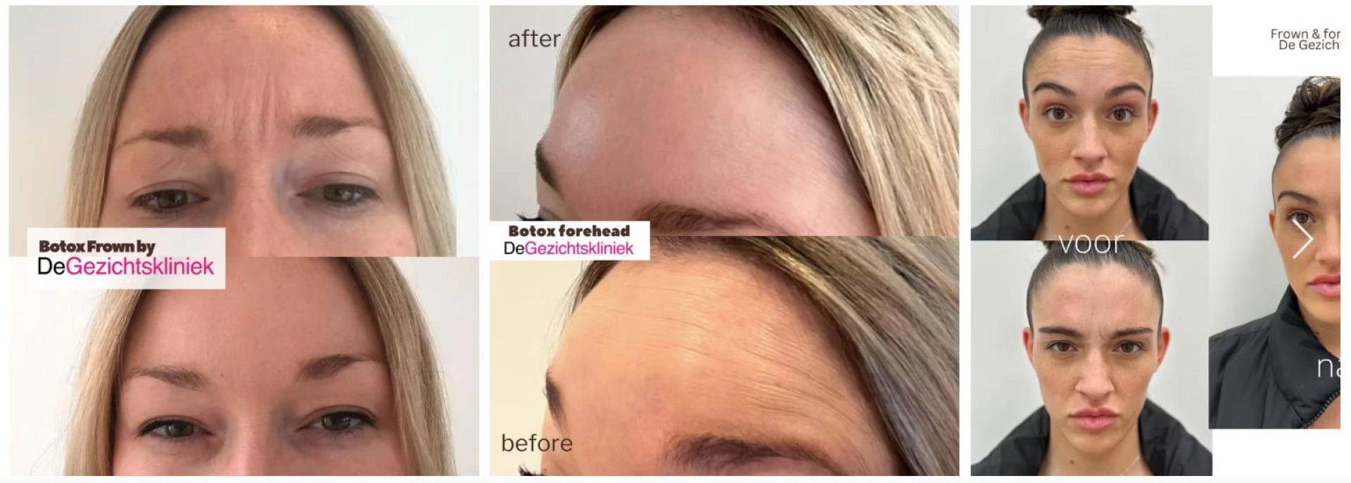 Why De Gezichtskliniek is the Best Botox Treatment Clinic in Amsterdam for All Types of Botox Needs