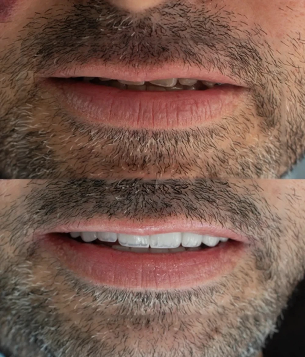 Composite vs Traditional Veneers: Find the Best Fit for Your Perfect Smile