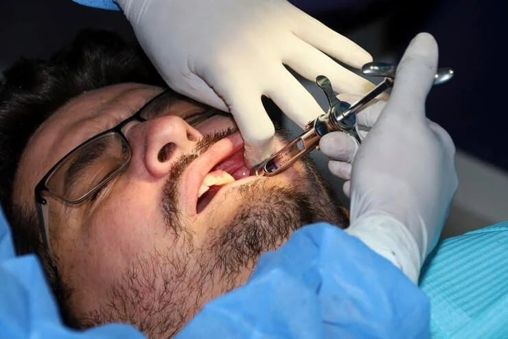 Why Wisdom Teeth Removal in Oxnard Is Essential for Oral Health