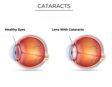 A Guide to Cataract Surgery in Mauritius: What to Expect at Spectra Eye Hospital    