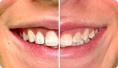 How Mini Dental Implants Work