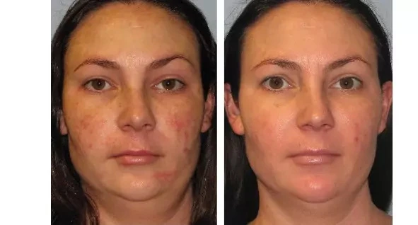 Transforming Skin, Restoring Confidence: The Ultimate Guide to Acne Scar Treatment
