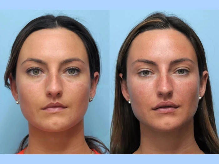 Enhance Your Natural Beauty with the Best Plastic Surgeons in Dubai for Thread Lift