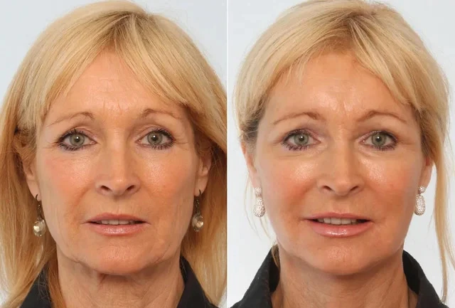 Your Guide to Face Lift Surgery in Cape Town South Africa — Techniques, Recovery & Costs