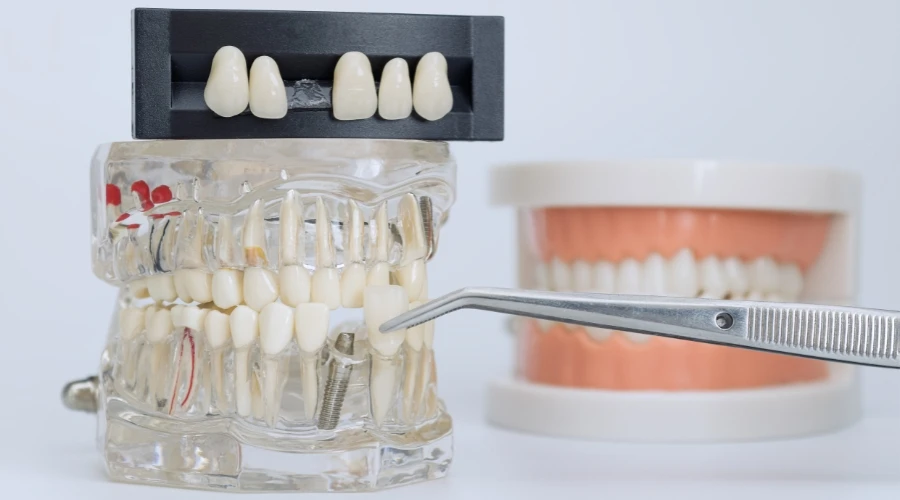 Dental Crowns Made Simple: What to Expect from Start to Finish