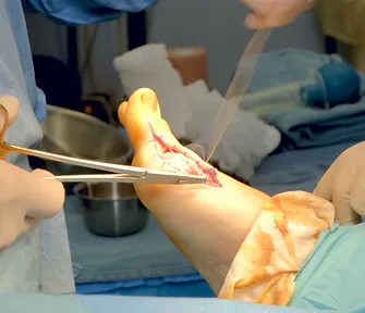 What Type of Doctor Is Best for Foot Surgery?