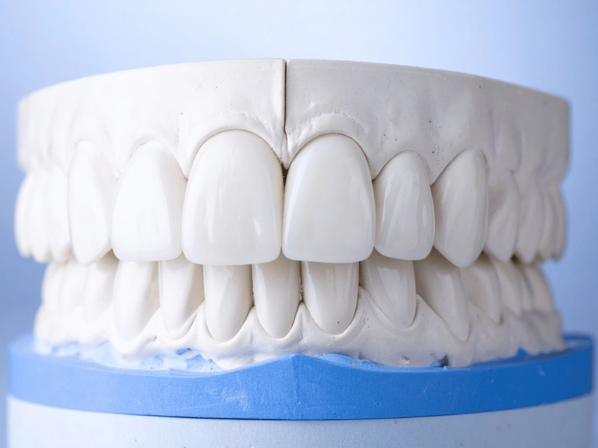 How Much Does a Tooth Implant Cost in India? 