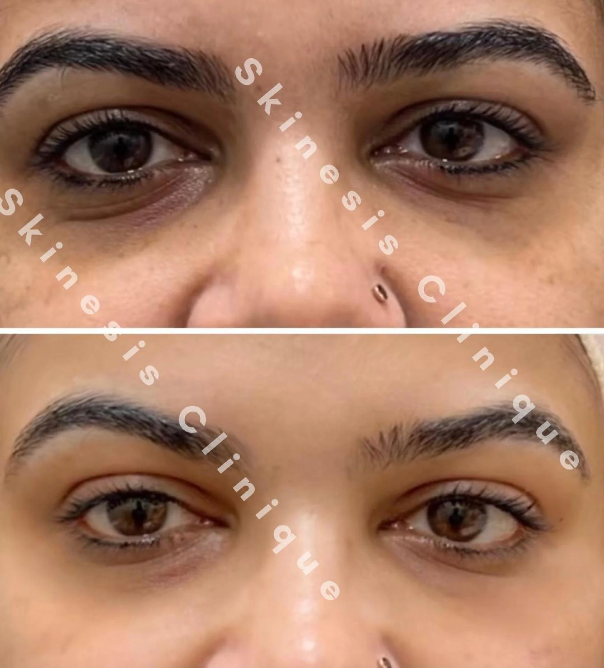 Under-Eye Hollowness: How Dermal Fillers Are the Wonder Treatment — With Skinesis Clinique Leading the Way