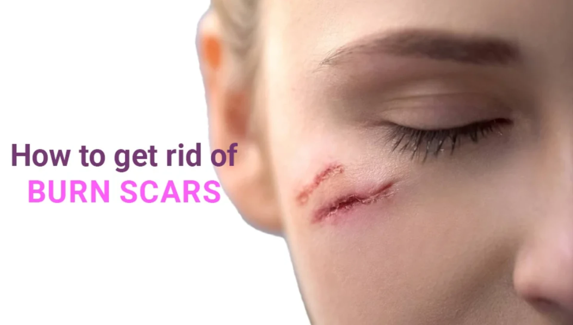 How to Get Rid of Burn Scar
