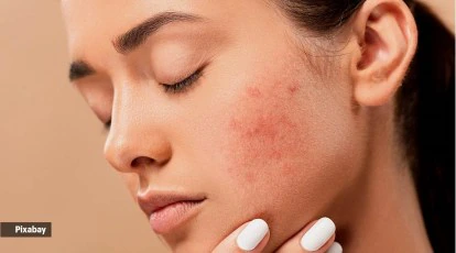 10 Tips Para Mawala ang Pimples: Mahalaga at Epektibong Gabay Mula sa Nation Lifestyle