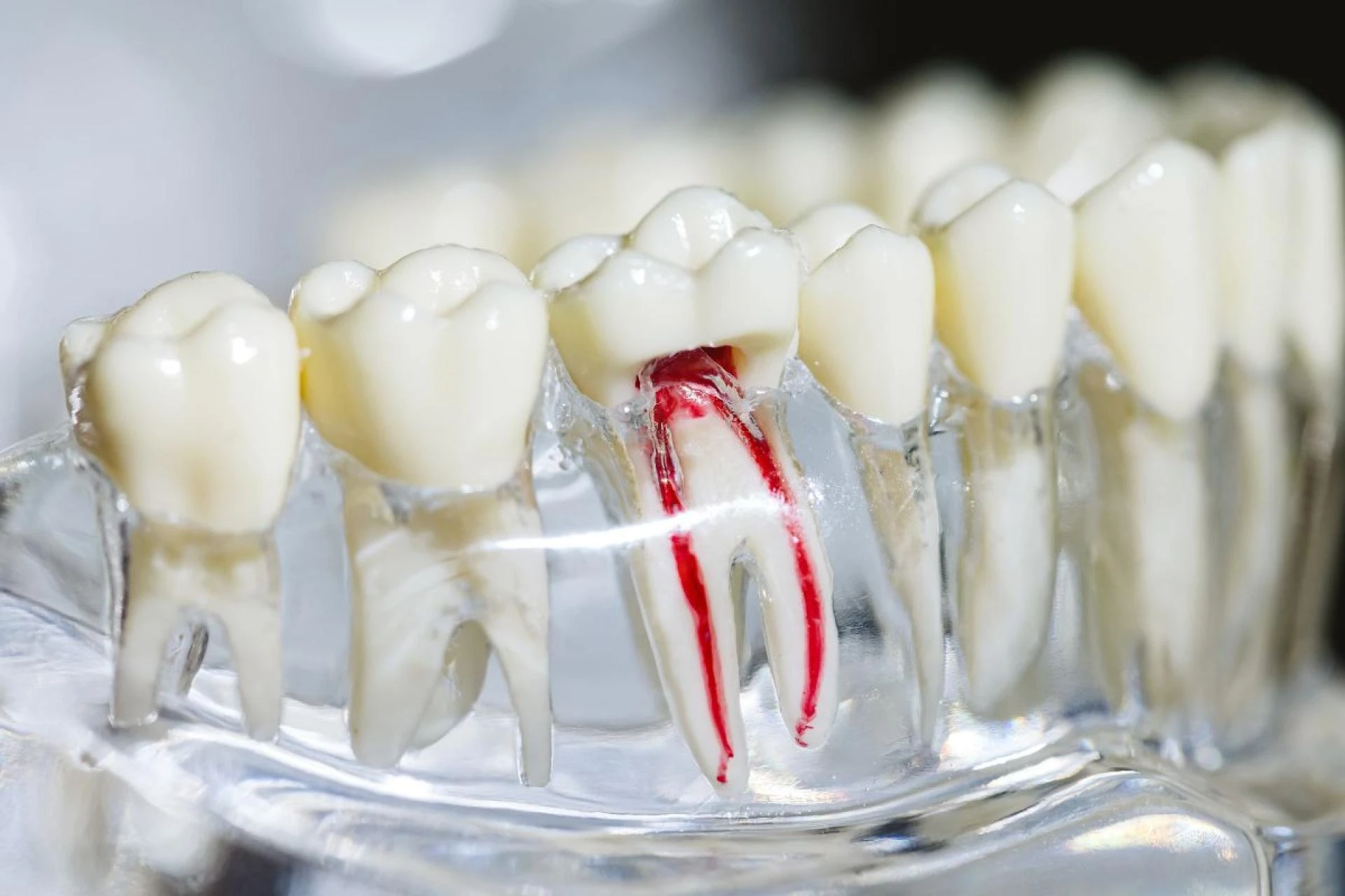 Saving Your Smile with Expert Root Canal Mundelein Treatment