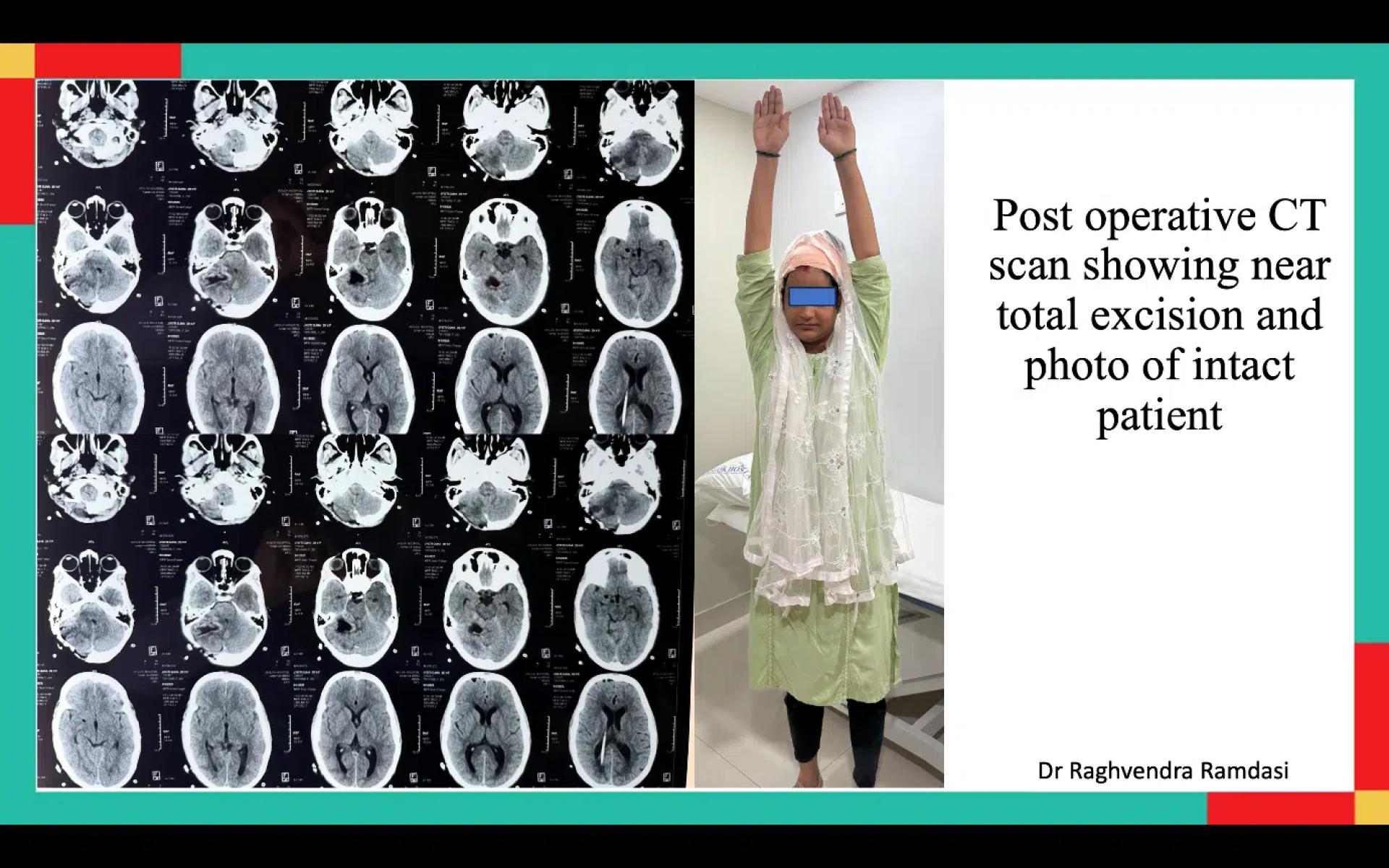 When a Common Brain Tumor Isn’t So Common: A Rare Case of CPA Medulloblastoma In An Adult