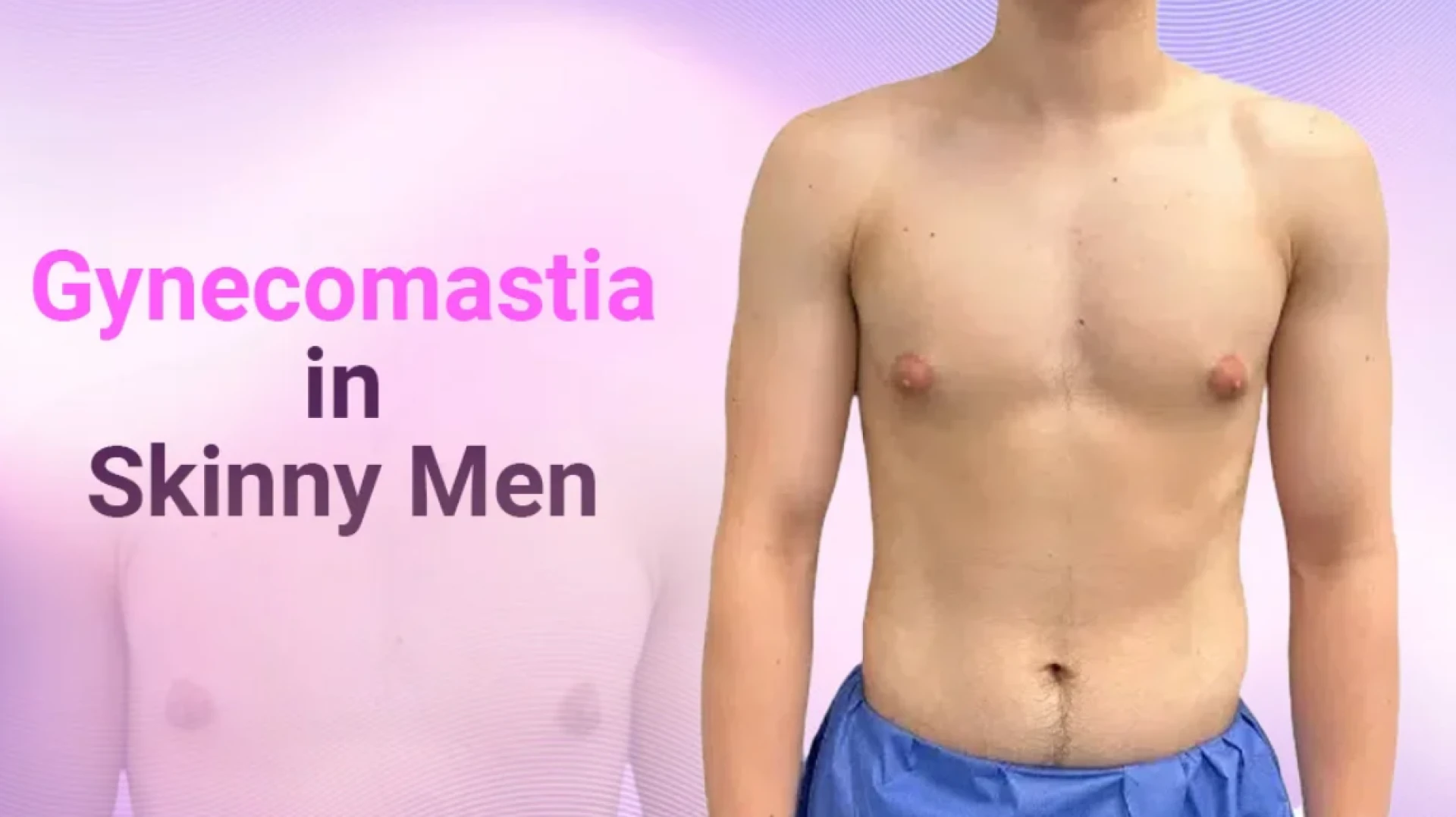 Gynecomastia in Skinny Men