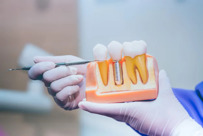 Finding the Best Dental Implants Near You in Manchester 