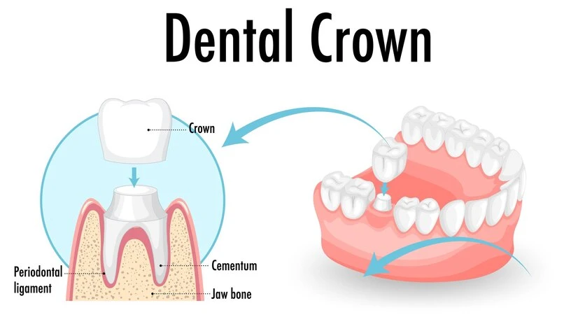 Dental Crowns Treatment &amp; Cost in Mumbai