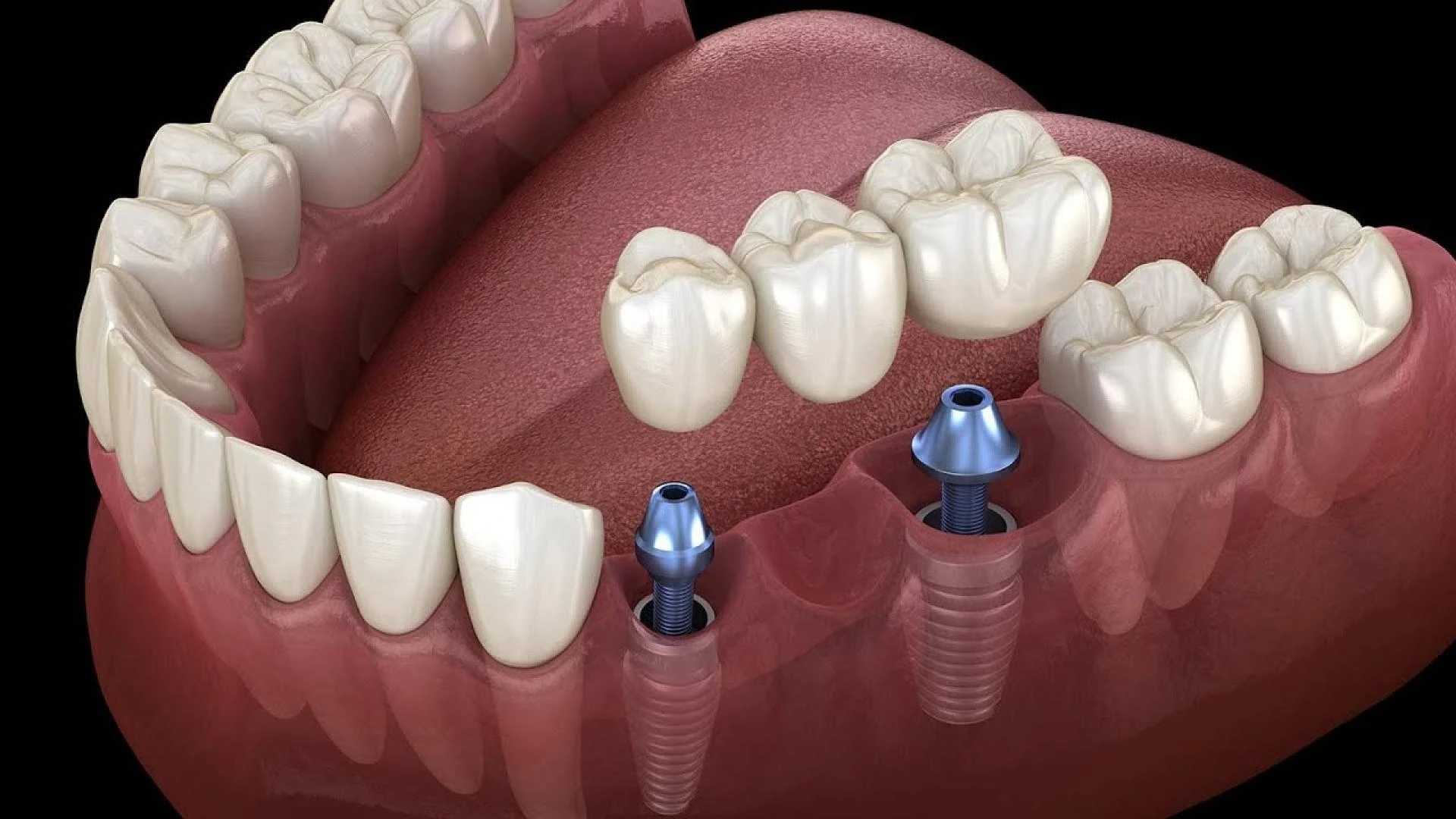 Dental Implants in Fayetteville NC – Restore Your Smile with Confidence