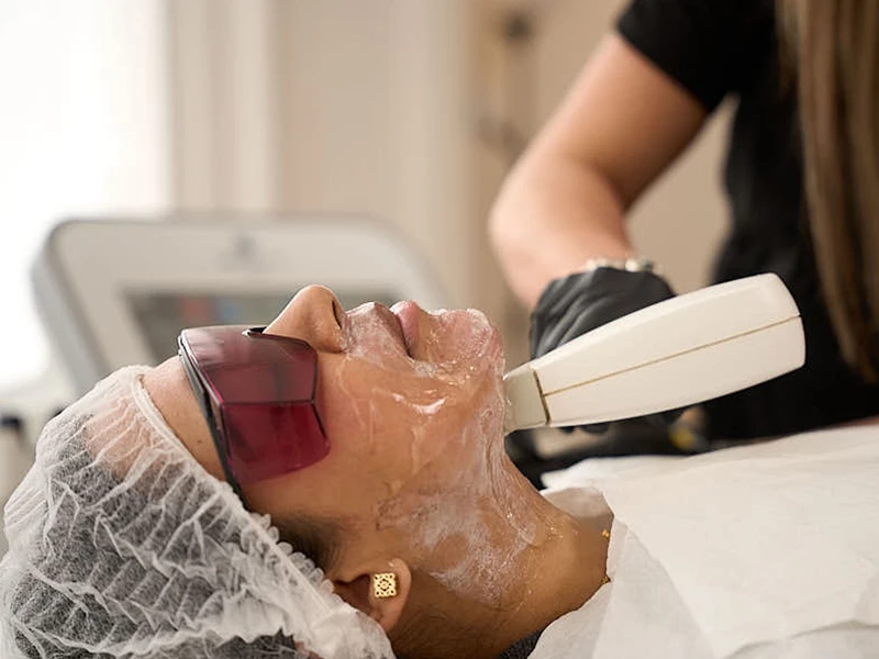 Fractional Laser Treatment in London: The Science Behind Skin Renewal