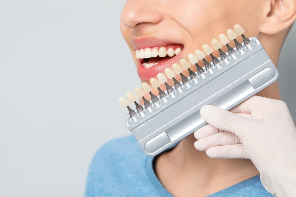 How Custom Veneers Can Perfect Your Smile in Miami Florida
