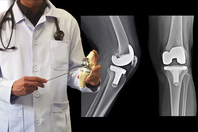Top FAQs About Knee Joint Replacement in Delhi Answered by Experts