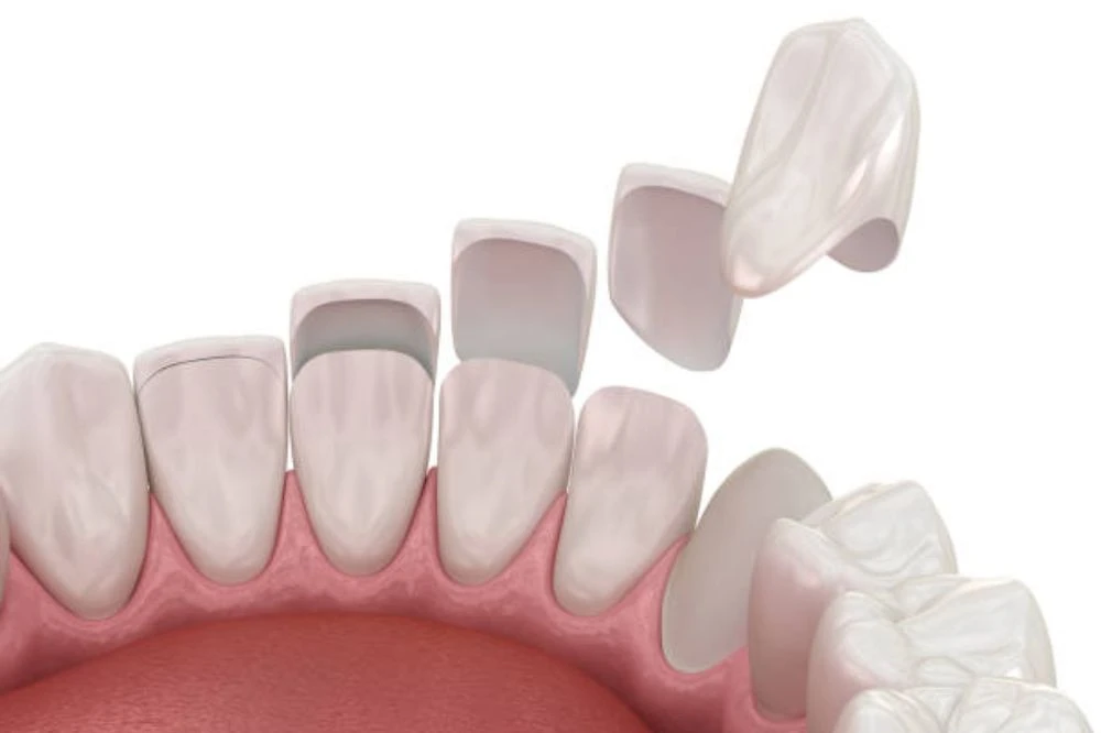 How many veneers do I need for a full smile makeover?