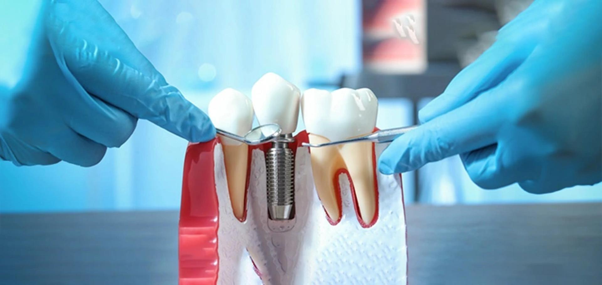 Dental Implant Cost in India and Delhi Shared by The Dental Roots