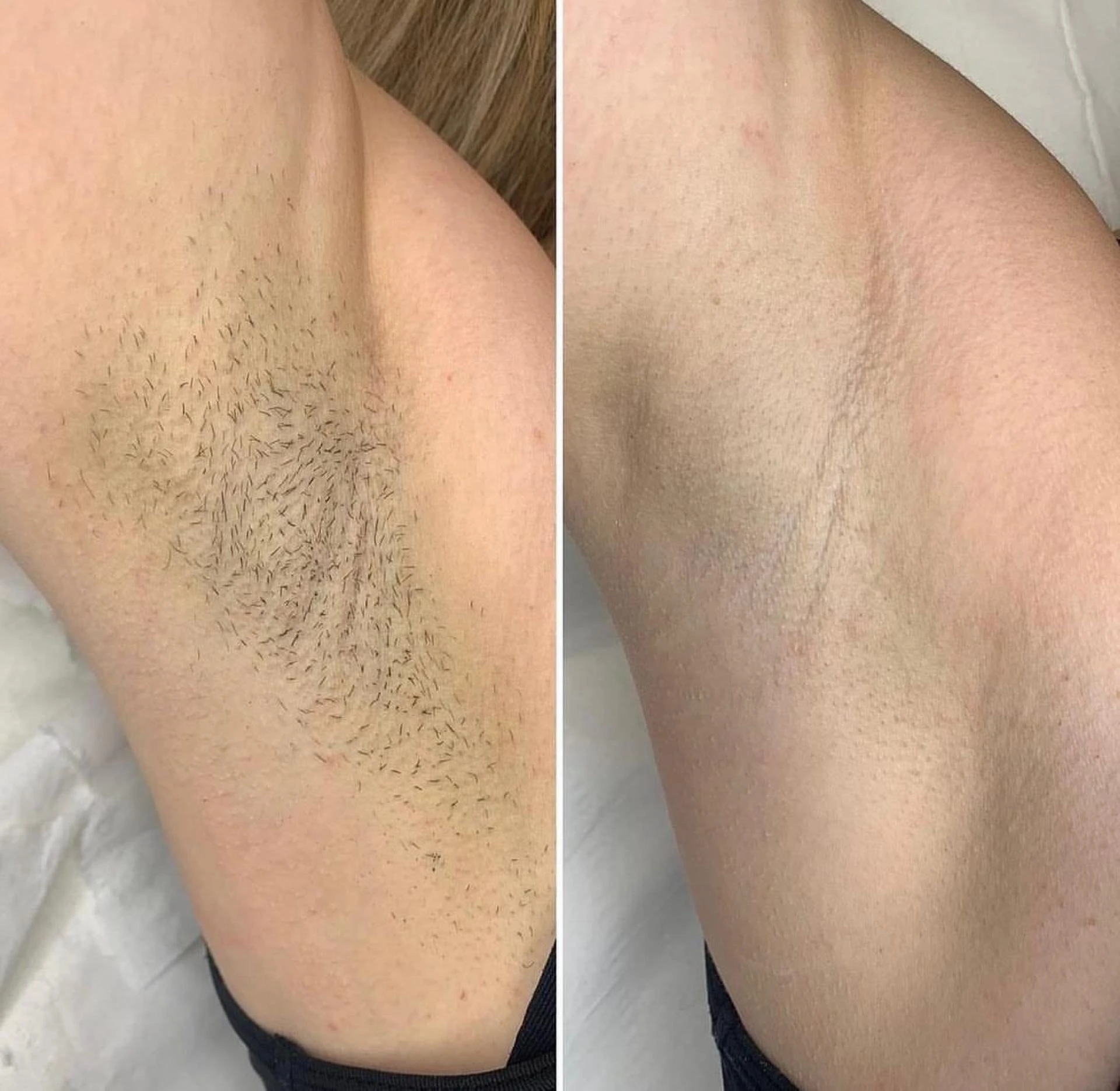 Laser Hair Removal at Skinesis Clinique (skin clinic at Vasant Vihar, Delhi)