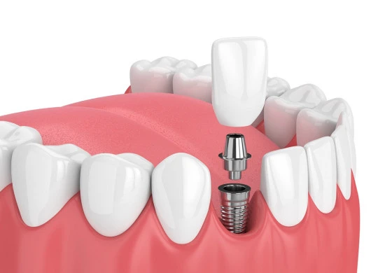 What Are the Benefits of Dental Implants in Dubai?