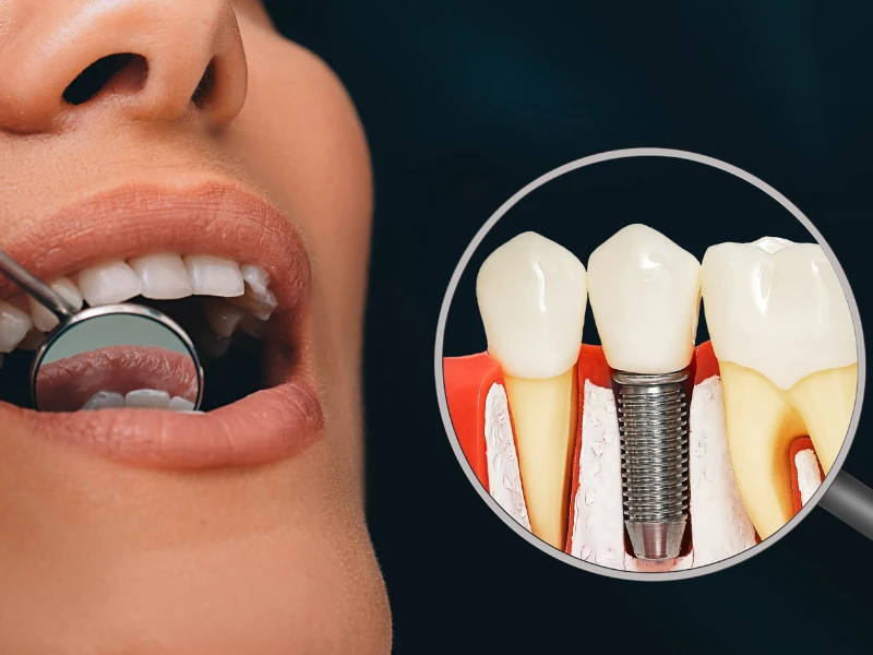 The Ultimate Guide to Dental Implants: Benefits, Procedure, and Aftercare