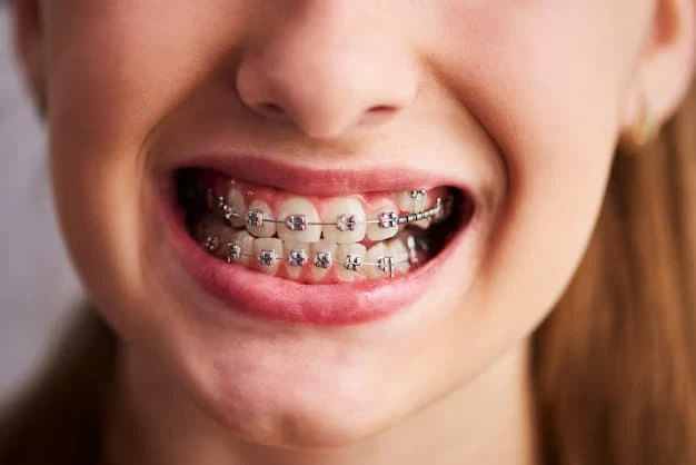 Why Traditional Metal Braces Are Still a Popular Orthodontic Option