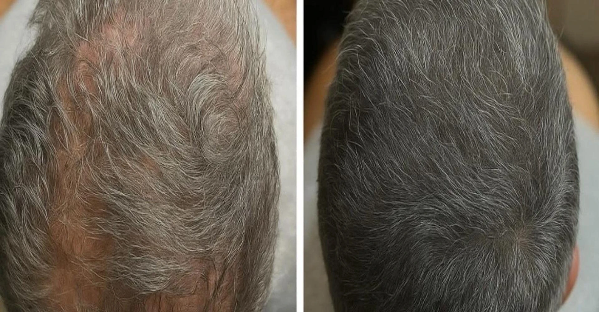 Scalp Micropigmentation in California: The Leading Solution for Thinning Hair and Density Restoration