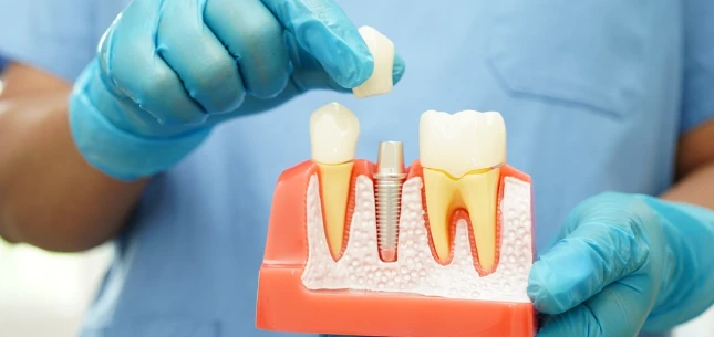 Dental Implants vs. Dental Bridges: Which Tooth Replacement Option Is Right for You?Draft: My Post Title