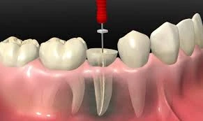 What Is Root Canal Treatment? Step-by-Step Guide