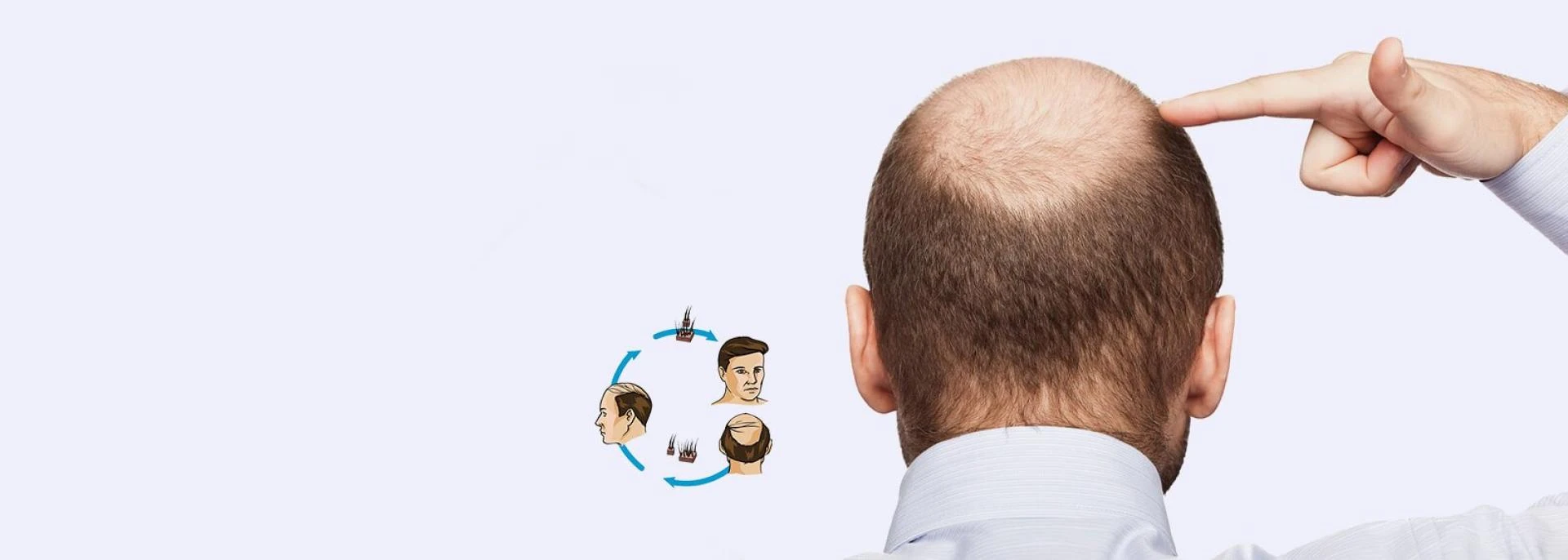 FUE Hair Transplant Cost in India at MedLinks Hair Transplant Clinic.