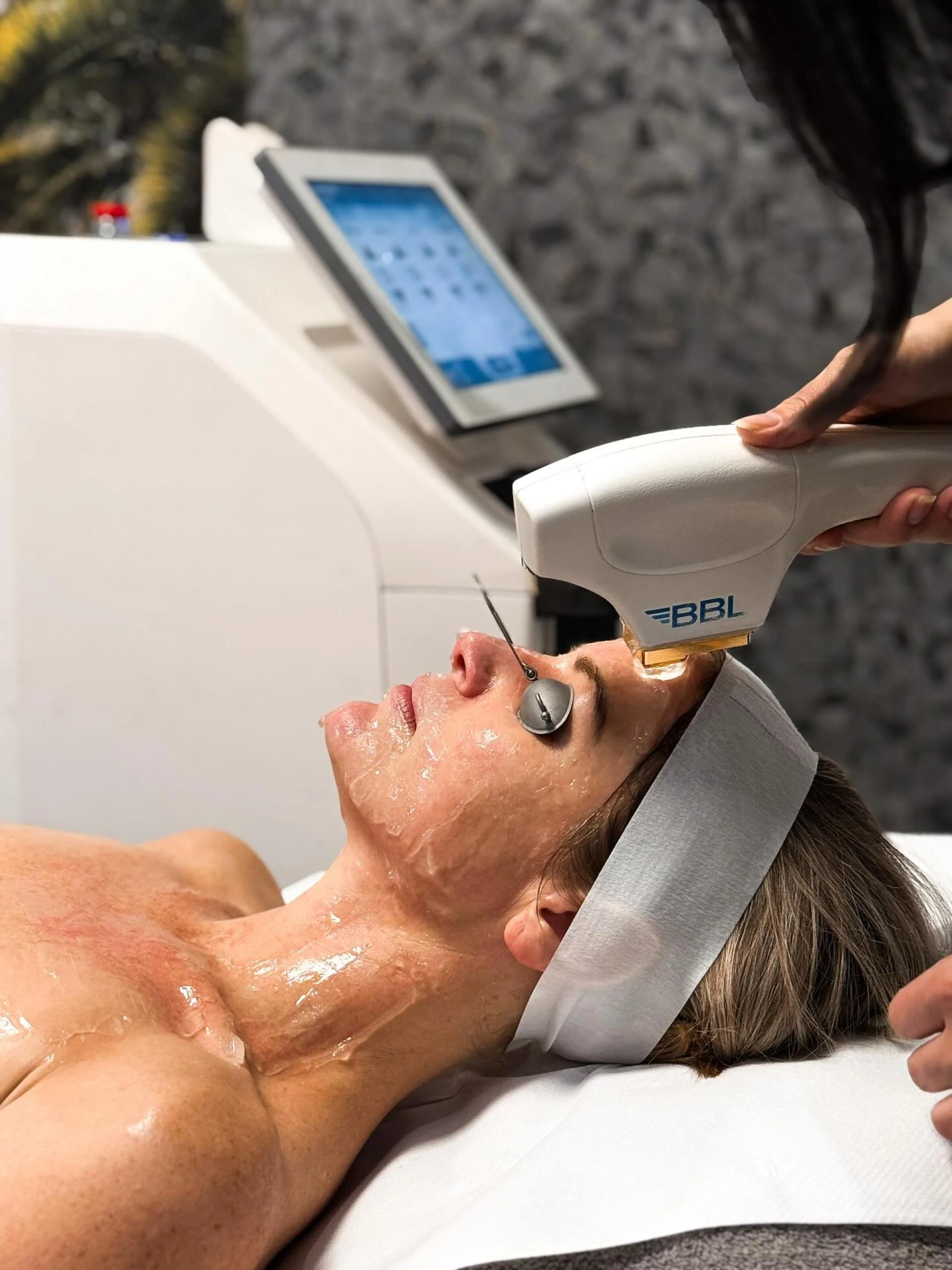 Ablative Laser Resurfacing: Deep Skin Renewal vs. Recovery Time