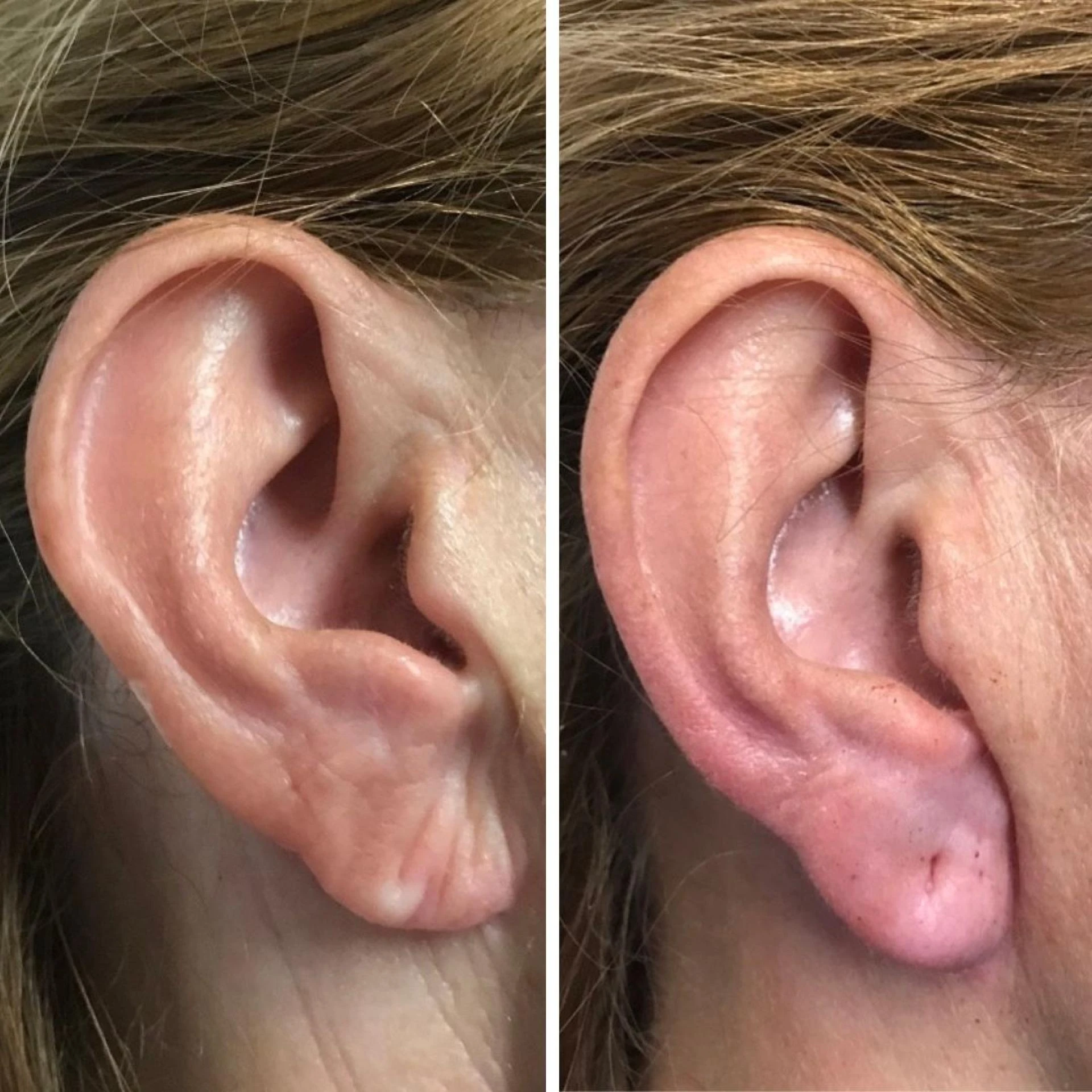 How Painful Is Earlobe Correction Surgery?