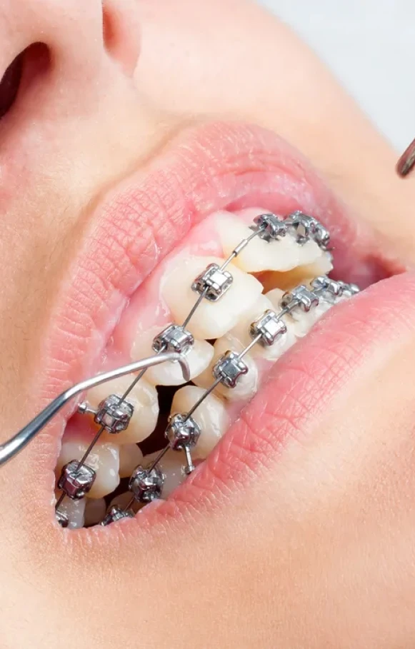 Bankstown Orthodontics for Confident Smiles | Smile Line Dental
